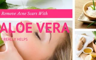 Remove Acne Scars With Aloe Vera