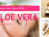 Remove Acne Scars With Aloe Vera